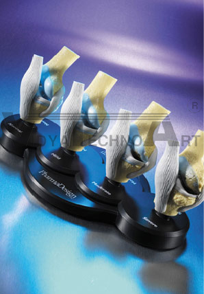 Four-Stage Osteoarthritis Knee Model